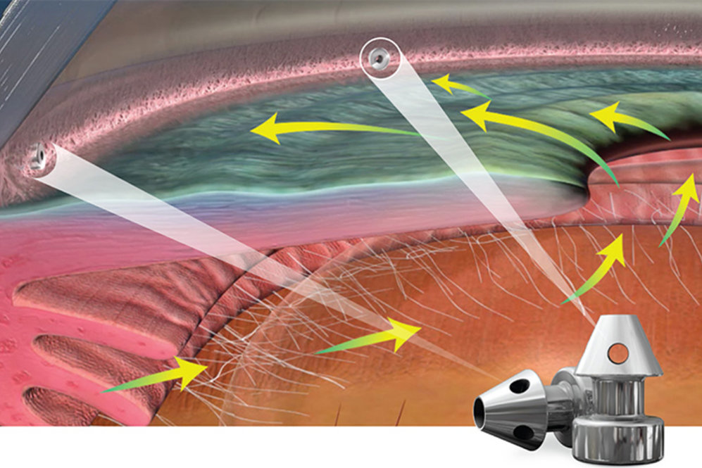 Advanced-Treatment-Options-for-Glaucoma