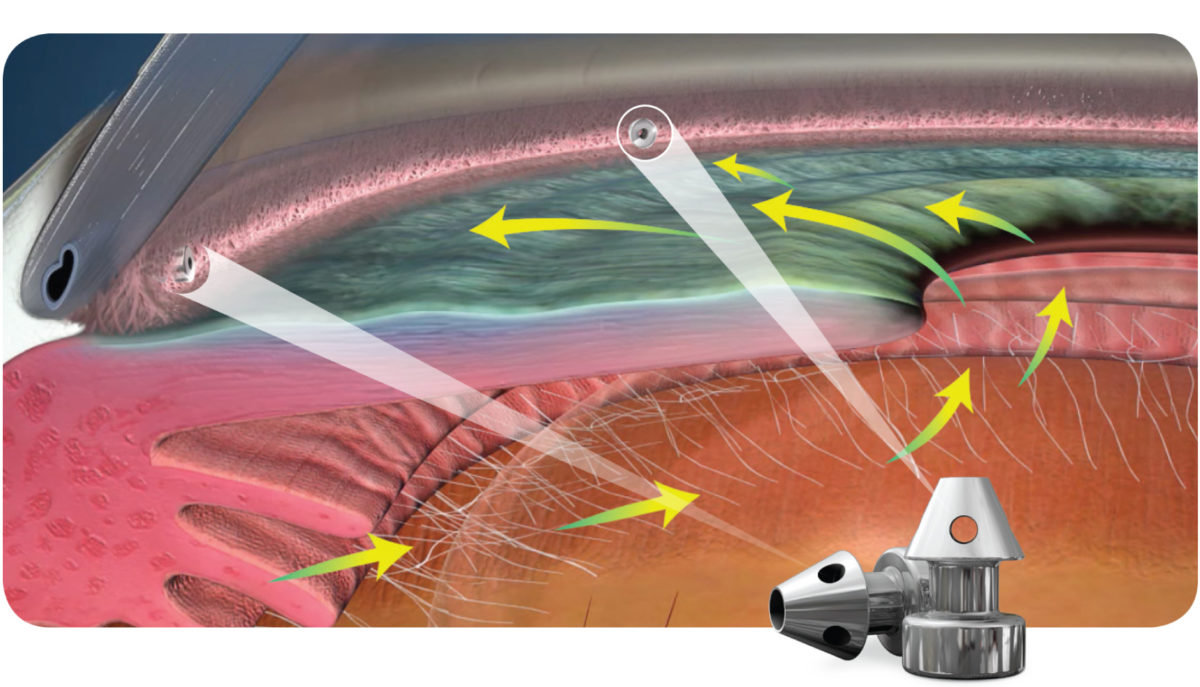 Advanced Treatment Options For Glaucoma - SINCHAIEYE, Orange, CA